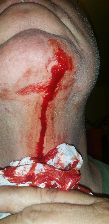 Bleeding.jpg